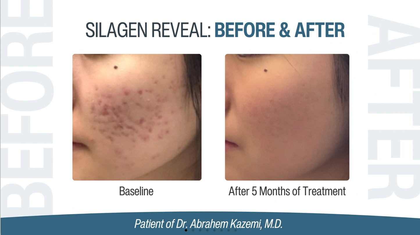 Silagen Reveal before and after acne mark refinement photo showing baseline and five month improvement in skin tone results.