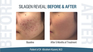 Silagen Reveal before and after acne mark refinement photo showing baseline and five month improvement in skin tone results.