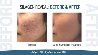 Silagen Reveal before and after acne mark refinement photo showing baseline and five month improvement in skin tone results.