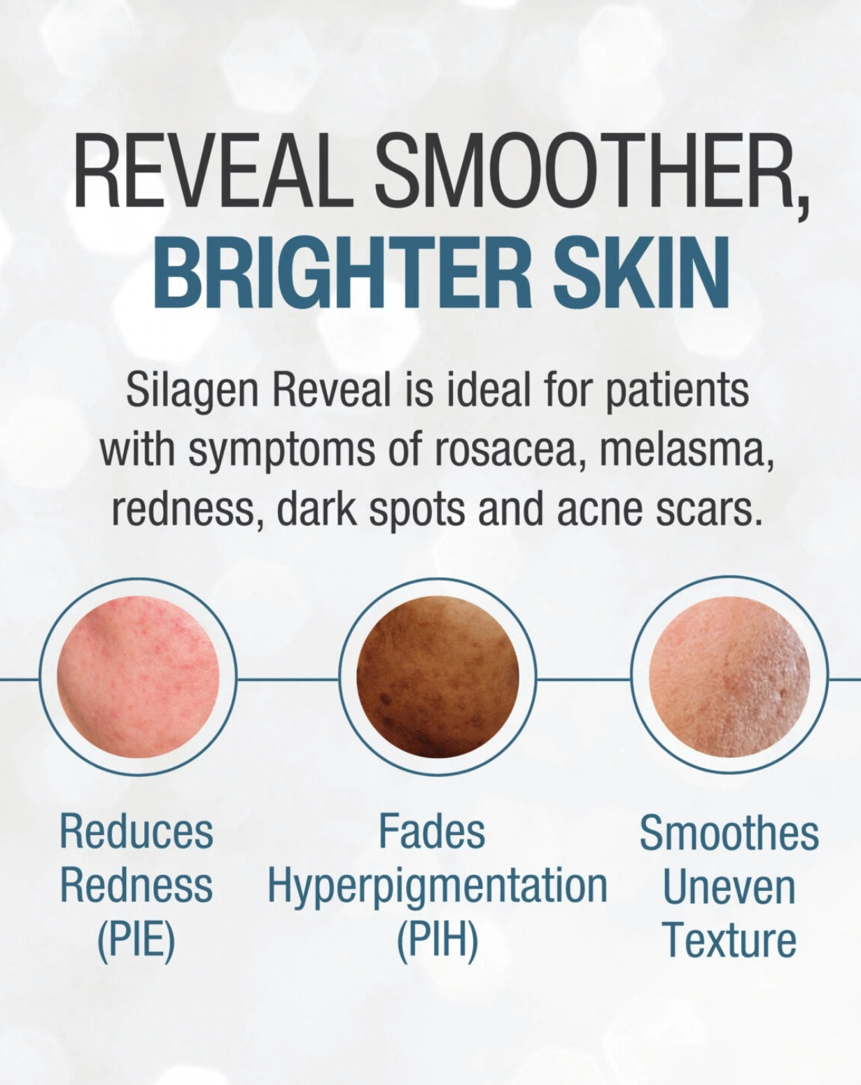 Silagen Reveal graphic for smoother brighter skin, redness, hyperpigmentation, dark spots, and acne scar texture