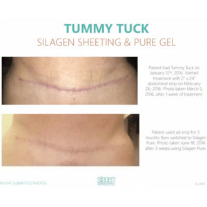 Tummy tuck scar treatment timeline with Silagen: Before photo taken March 5, 2016 after one week of using the abdominal strip, and after photo taken June 18, 2016 following three months of strip use and three weeks of Silagen Pure gel.