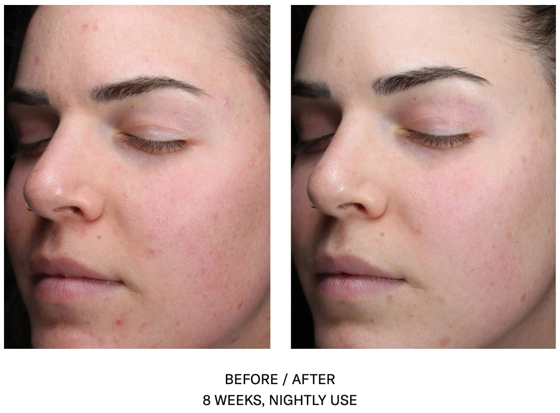 Before and after 8 weeks of SkinBetter AlphaRet Clearing Serum showing reduced acne and clearer skin appearance