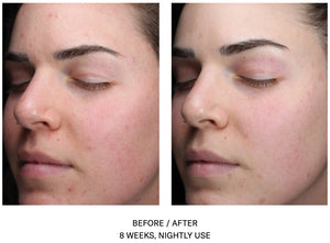 Before and after 8 weeks of SkinBetter AlphaRet Clearing Serum showing reduced acne and clearer skin appearance