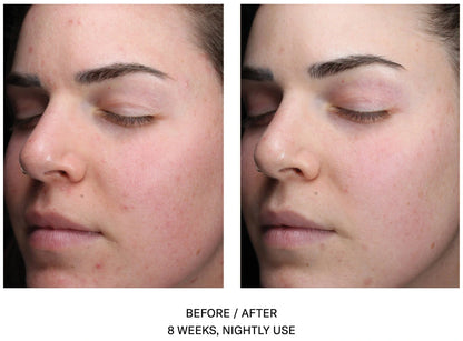 Before and after 8 weeks of SkinBetter AlphaRet Clearing Serum showing reduced acne and clearer skin appearance