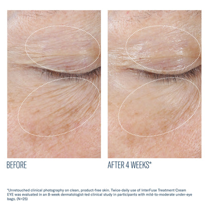 Before and after 4 weeks using SkinBetter InterFuse eye cream showing reduced wrinkles and smoother under eye skin