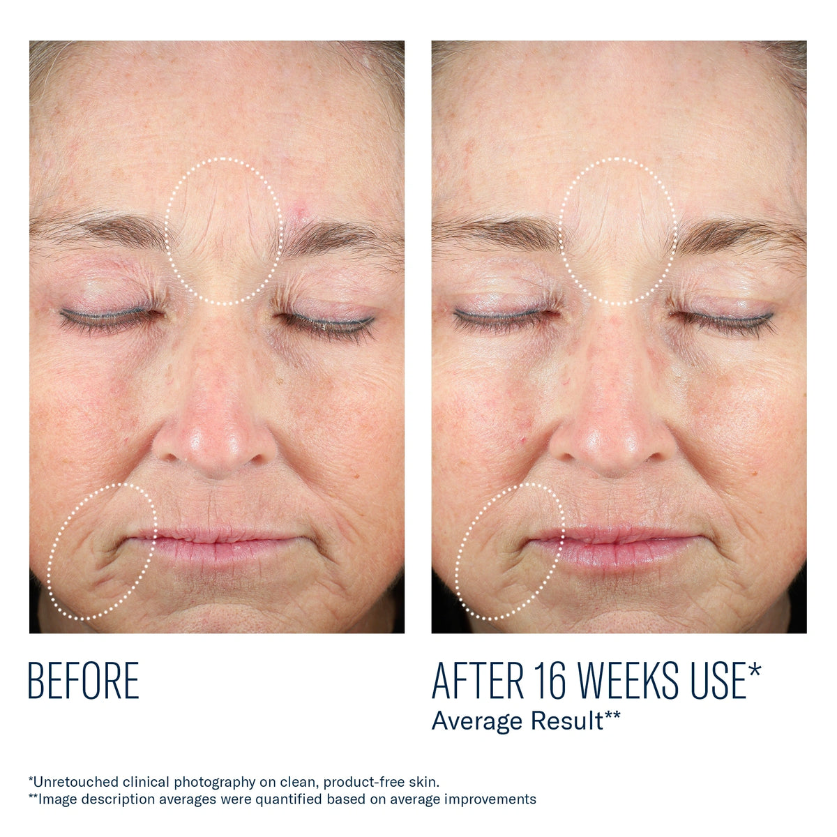 Before and after 16 weeks of SkinBetter Mystro Revive Renewing Serum showing improved skin texture and reduced lines