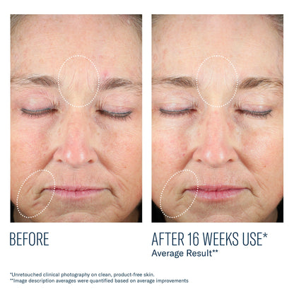 Before and after 16 weeks of SkinBetter Mystro Revive Renewing Serum showing improved skin texture and reduced lines