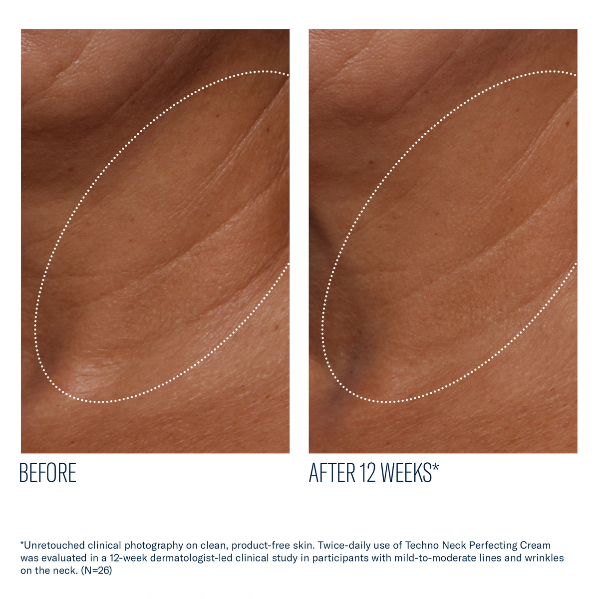 Before and after 12 weeks of SkinBetter Techno Neck Perfecting Cream showing reduced neck lines and smoother skin