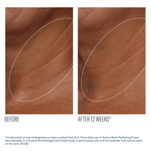 Before and after 12 weeks of SkinBetter Techno Neck Perfecting Cream showing reduced neck lines and smoother skin