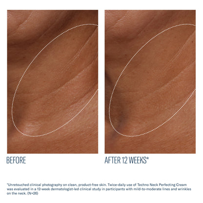Before and after 12 weeks of SkinBetter Techno Neck Perfecting Cream showing reduced neck lines and smoother skin