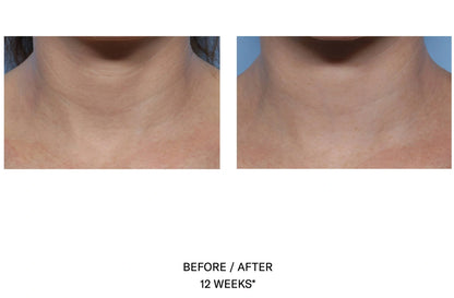 Before and after 12 weeks of SkinBetter Techno Neck Perfecting Cream showing improved neck whitener and smoother skin