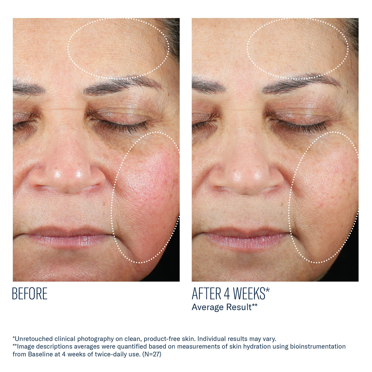 Before and after 4 weeks using SkinBetter Trio Luxe Moisture Treatment showing improved hydration and smoother skin