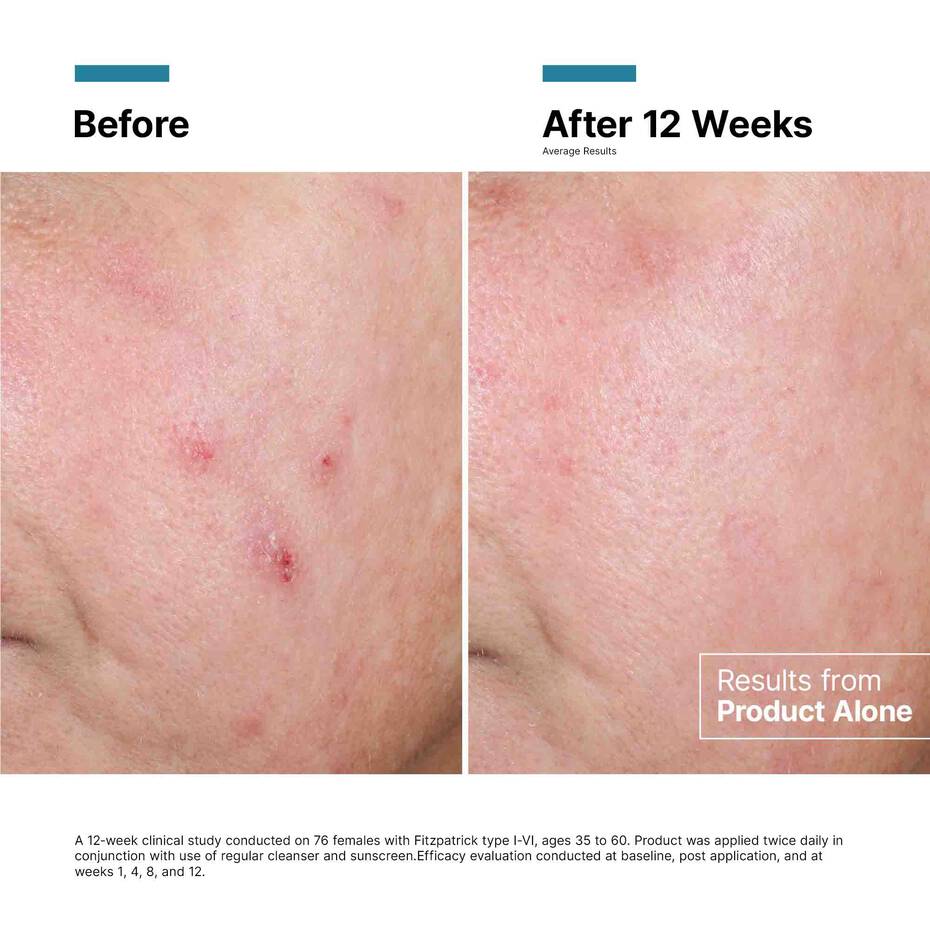 Before and after at 12 weeks showing clinical results from SkinCeuticals Advanced RGN-6 regenerative cream used alone.