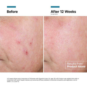 Before and after at 12 weeks showing clinical results from SkinCeuticals Advanced RGN-6 regenerative cream used alone.