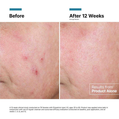 Before and after at 12 weeks showing clinical results from SkinCeuticals Advanced RGN-6 regenerative cream used alone.