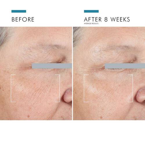 Before and After 8 Weeks Comparison of Skin with SkinCeuticals A.G.E. Advanced Eye Cream Showing Visible Improvement