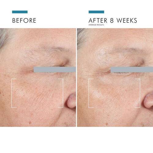 Before and after results at 8 weeks showing reduced under-eye aging with SkinCeuticals A.G.E. Advanced Eye treatment.