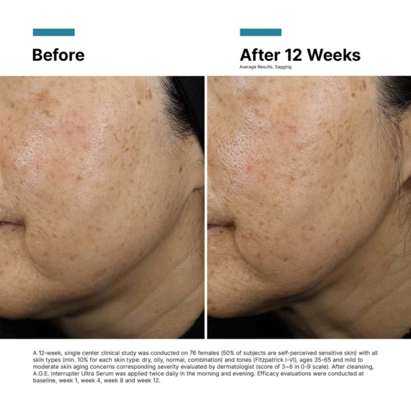 SkinCeuticals A.G.E. Interrupter Ultra Serum before and after 12 weeks showing average improvement in skin sagging.