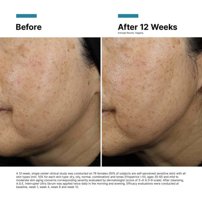 SkinCeuticals A.G.E. Interrupter Ultra Serum before and after 12 weeks showing average improvement in skin sagging.