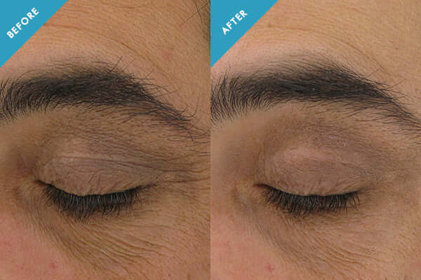 Before and after photo comparison showing reduced under-eye circles, puffiness, and signs of fatigue from SkinCeuticals AOX+ Eye Gel.