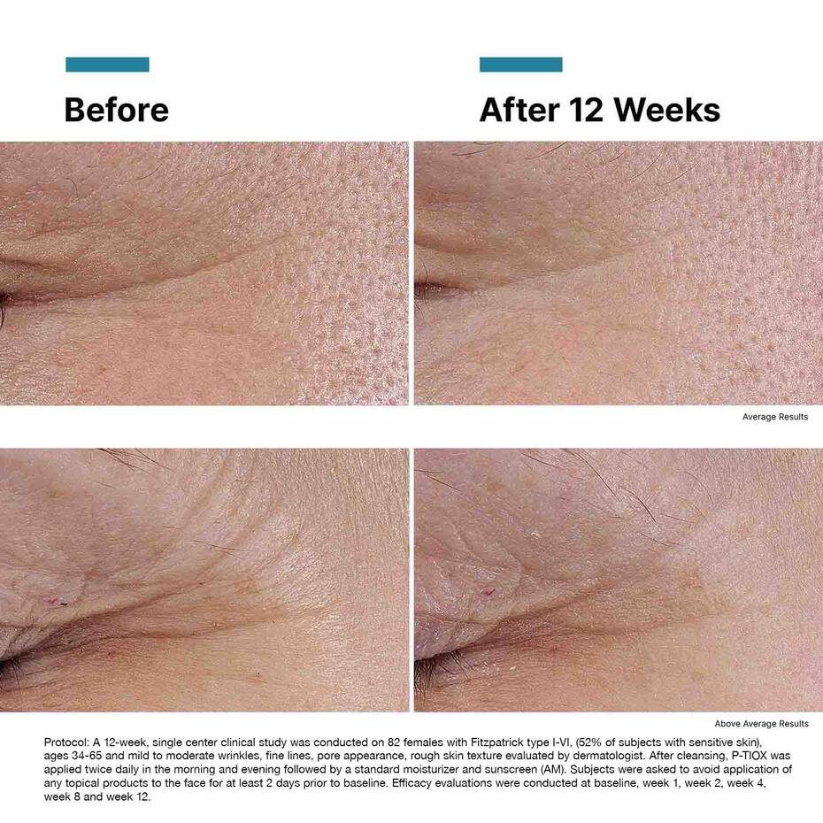 Clinical 12-week before and after for SkinCeuticals P-Tiox showing improved expression lines, texture, and radiance