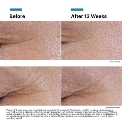 Clinical 12-week before and after for SkinCeuticals P-Tiox showing improved expression lines, texture, and radiance