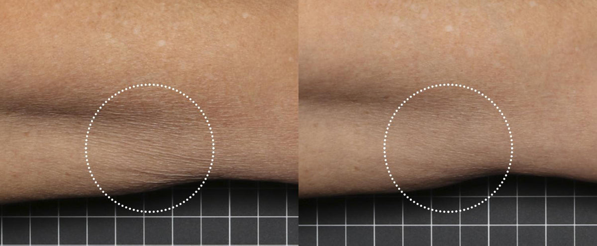 SkinMedica Firm & Tone Lotion before after arm result showing smoother crepey skin texture and improved body tone results now