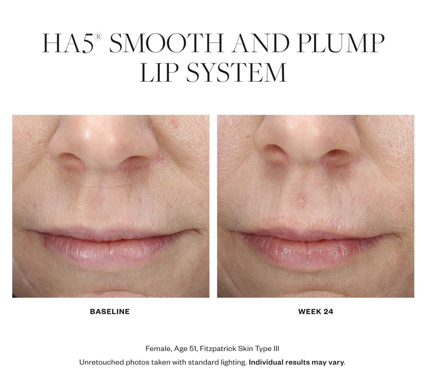 Before and after of SkinMedica HA5 Smooth & Plump Lip System showing fuller, hydrated lips after 24 weeks of use