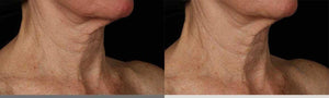 SkinMedica Neck Correct Cream before and after showing smoother neck lines and firmer-looking crepey skin in 12 weeks daily.