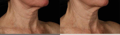 Before and after of SkinMedica Neck Correct Cream showing reduced wrinkles and firmer neck skin in the décolleté area