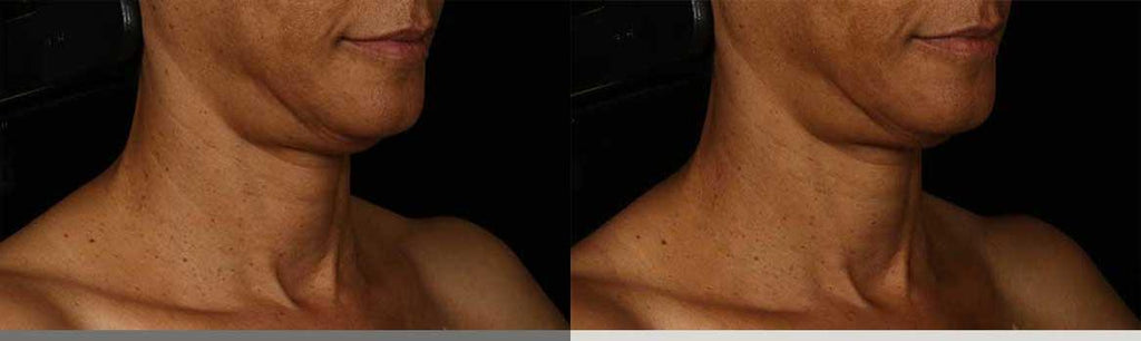 Before and after of SkinMedica Neck Correct Cream showing improved neck firmness and reduced sagging in the décolleté area