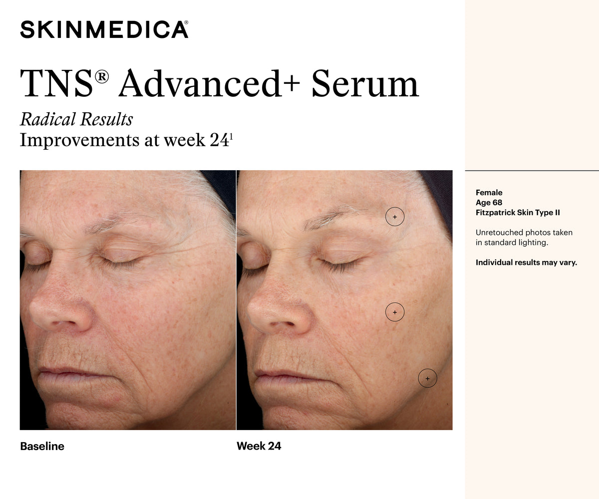SkinMedica TNS Advanced+ Serum results image at week twenty-four showing smoother texture and visibly refined wrinkles today