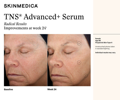 SkinMedica TNS Advanced+ Serum results image at week twenty-four showing smoother texture and visibly refined wrinkles today
