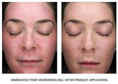 Sunbetter Tone Smart SPF 75 sunscreen before and after microneedling showing reduced redness smoother brighter skin