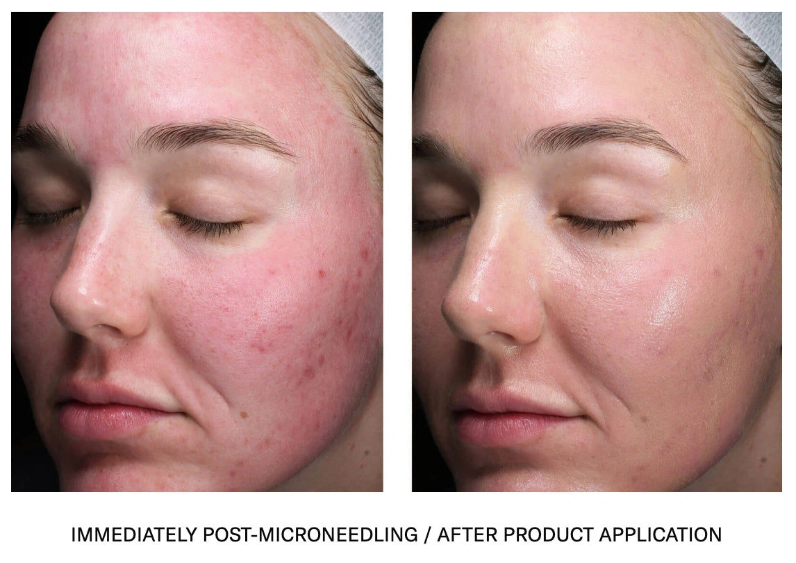 Sunbetter Tone Smart SPF 75 sunscreen before and after showing reduced redness and smoother skin post treatment