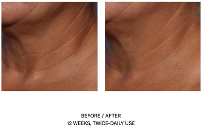 Before and after 12 weeks of SkinBetter Techno Neck Perfecting Cream showing smoother neck skin and reduced lines