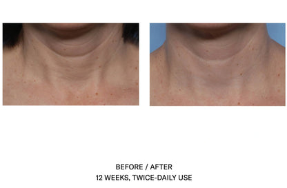 Before and after 12 weeks of SkinBetter Techno Neck Perfecting Cream showing improved neck firmness and smoother skin texture