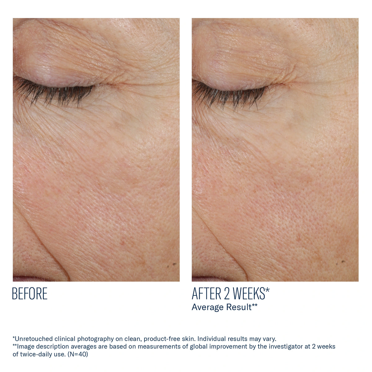 Before and after 2 weeks using SkinBetter Science Trio Rebalancing Moisture Treatment showing smoother hydrated skin