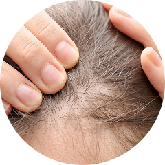 Thinning Hair