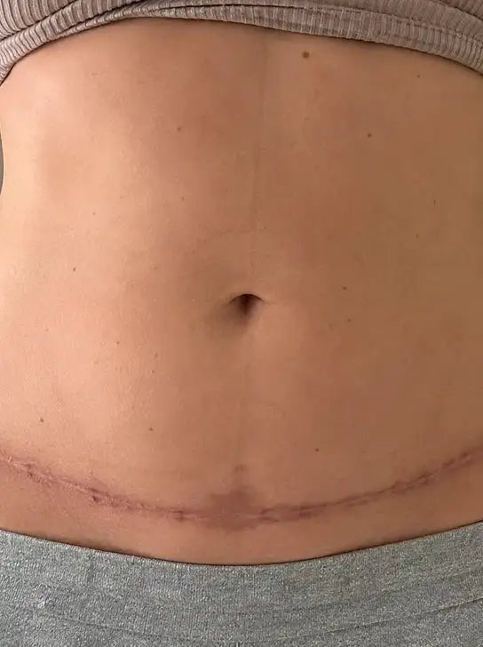 Scars