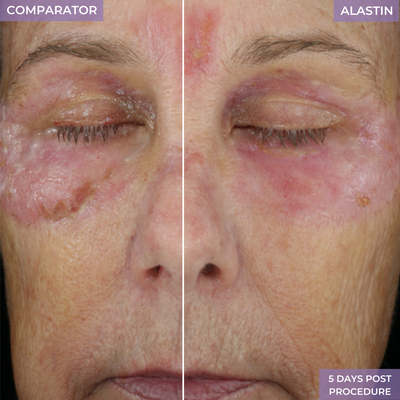 Alastin Skincare- Ultra Light Moisturizer before and after