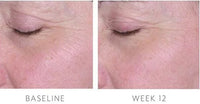 Biopelle- Tensage Stem Cell Eye Cream before and after