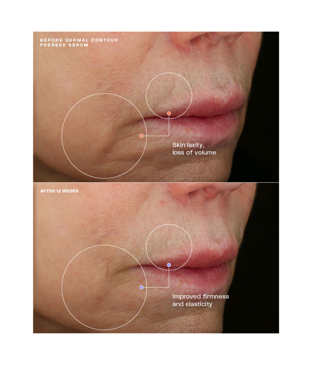 Dermal Contour Pressed Serum  before and after