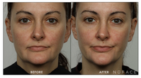 NuFACE- Effective Lip and Eye before and after