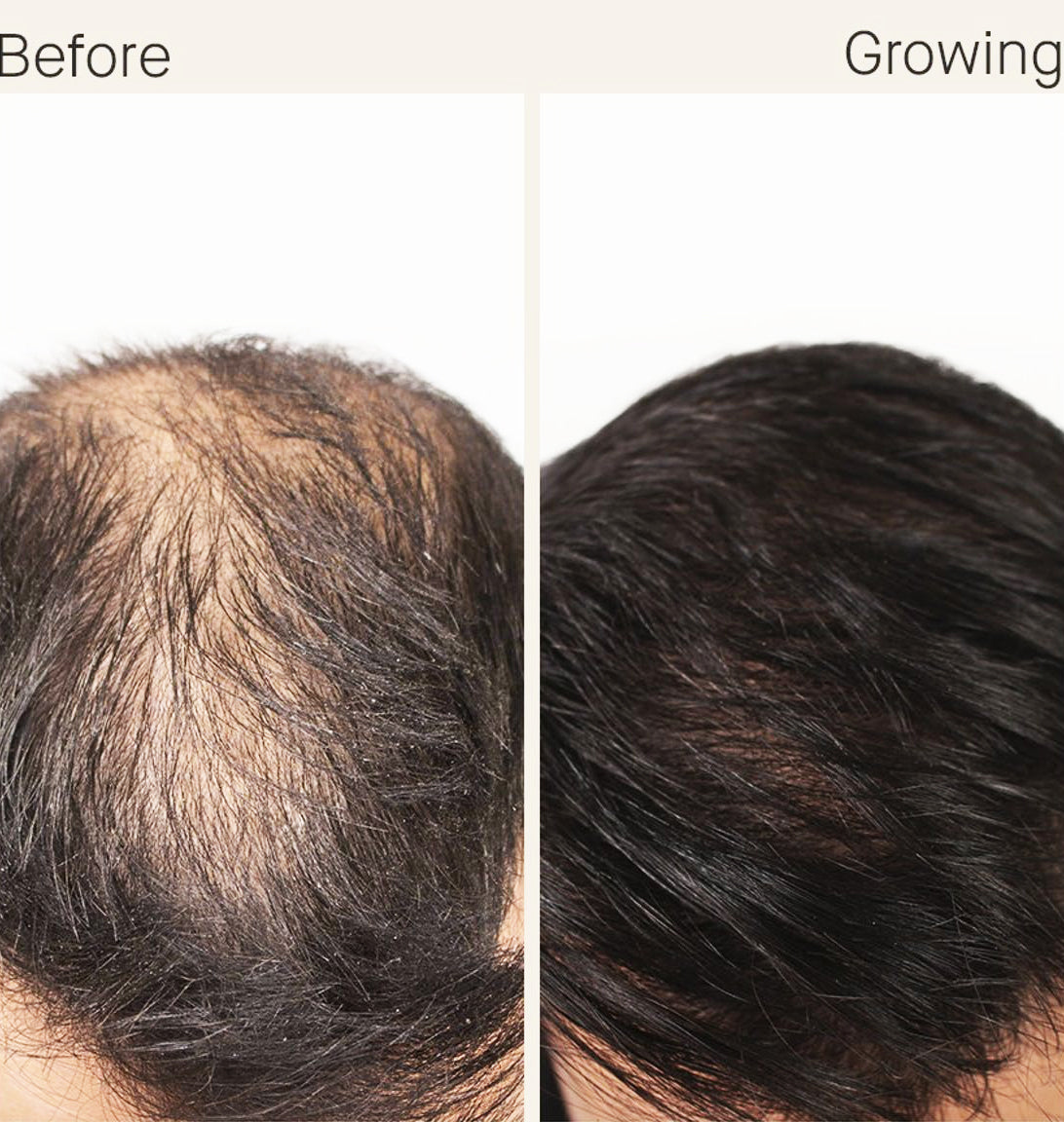Nutrafol- Hair Growth Activator before and after