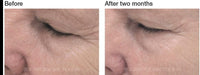PCA Skin ExLinea Peptide Smoothing Serum before and after