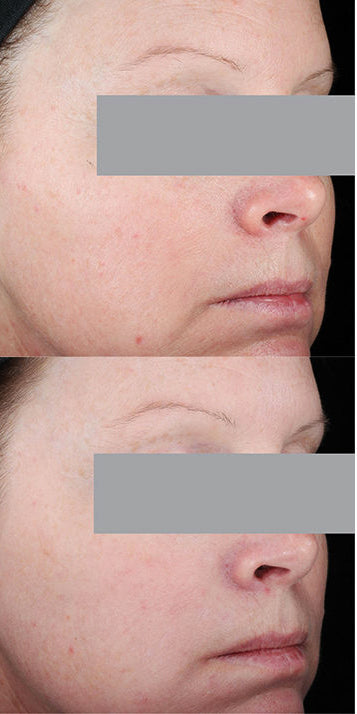 skinceuticals resveratrol b e before and after