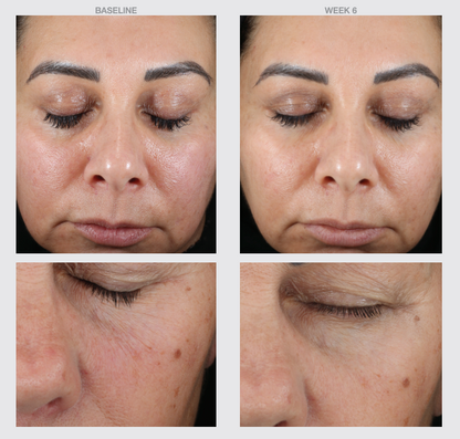 Before and after 6 weeks of using Retinol+ Skin Smoothing Brightening Cream, showing reduced facial lines