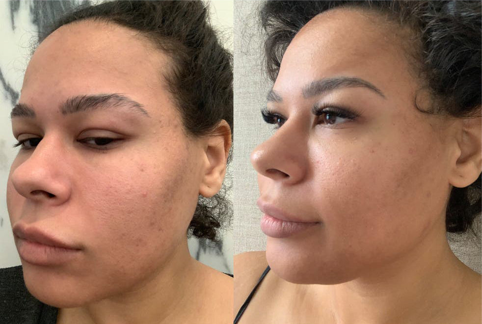 Revision Skincare- C+ Correcting Complex 30% before and after
