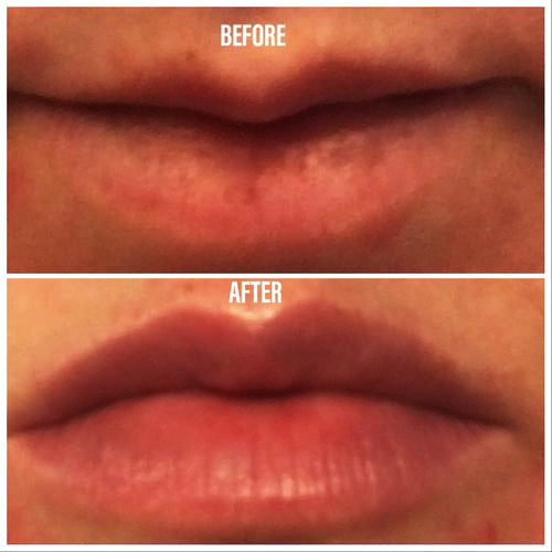 Revision Skincare YouthFull Lip Replenisher before and after